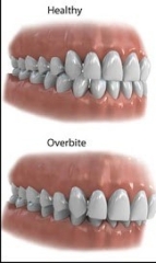 from Google. TMJ Normal & Overbite